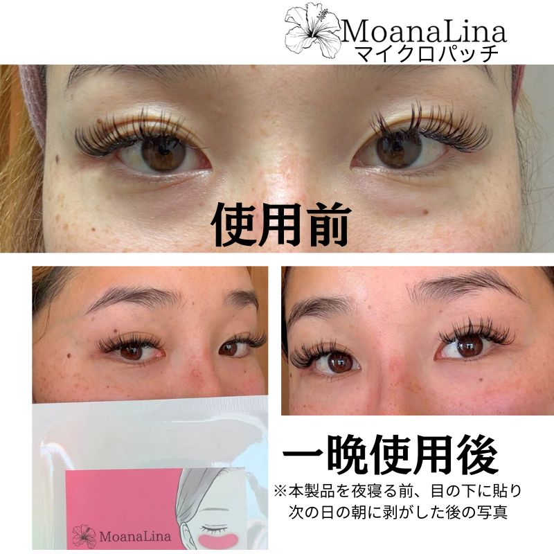 Before and After :100% Hyaluronic Acid Microneedle Eye Patch – Improves Dark Circles, Wrinkles, and Smile Lines